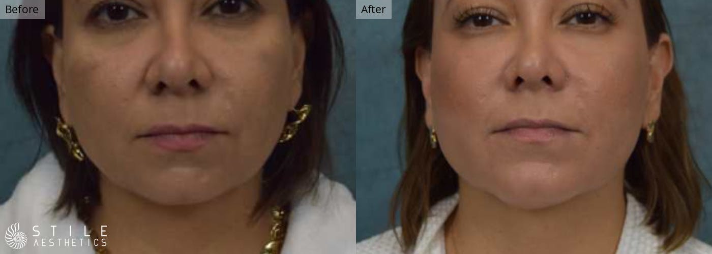 Chin Augmentation Before & After Gallery - Patient 278327 - Image 2