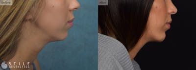 Chin Augmentation Before & After Gallery - Patient 137003 - Image 1