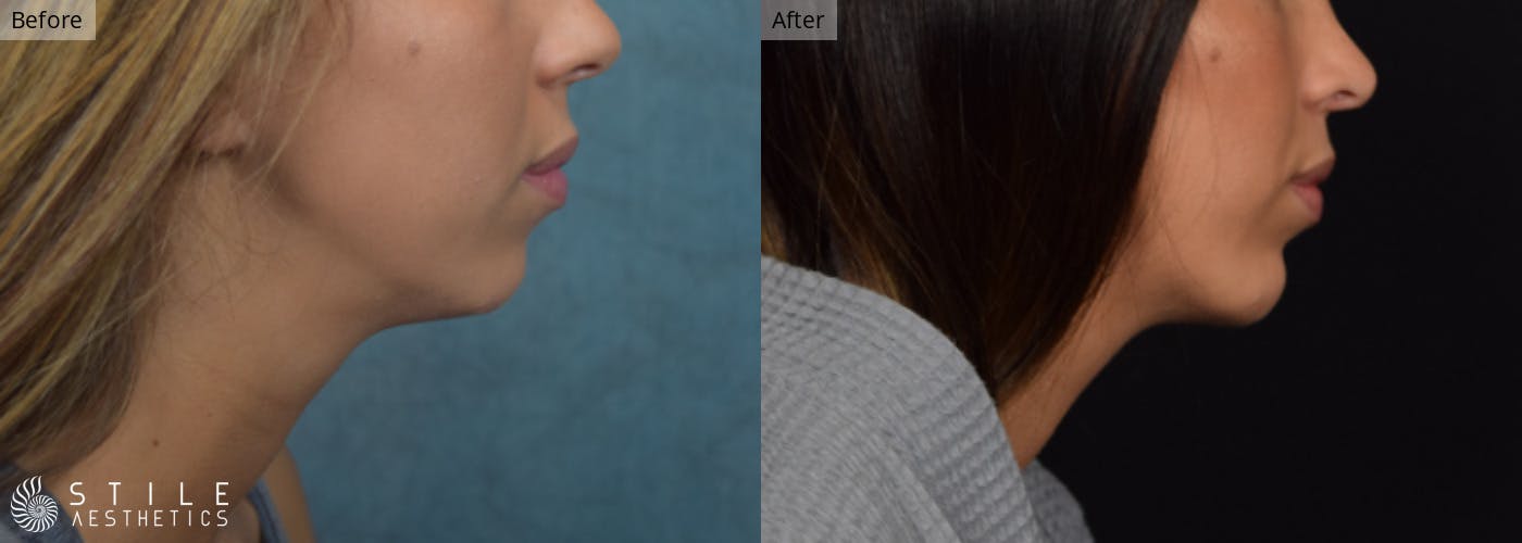 Chin Augmentation Before & After Gallery - Patient 137003 - Image 1