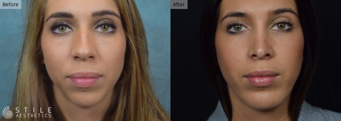 Chin Augmentation Before & After Gallery - Patient 137003 - Image 2