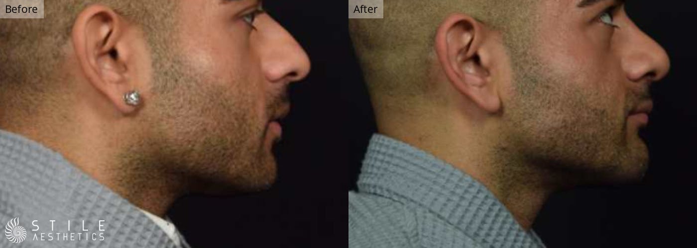Chin Augmentation Before & After Gallery - Patient 188345 - Image 1