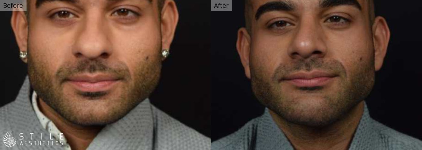 Chin Augmentation Before & After Gallery - Patient 188345 - Image 2