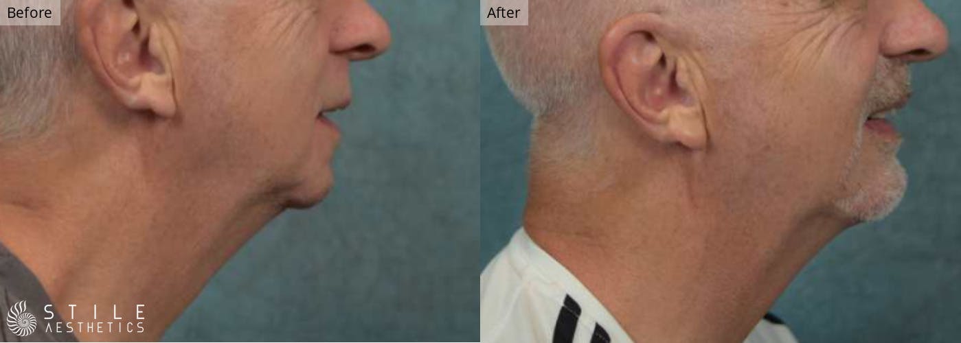Chin Augmentation Before & After Gallery - Patient 252188 - Image 1