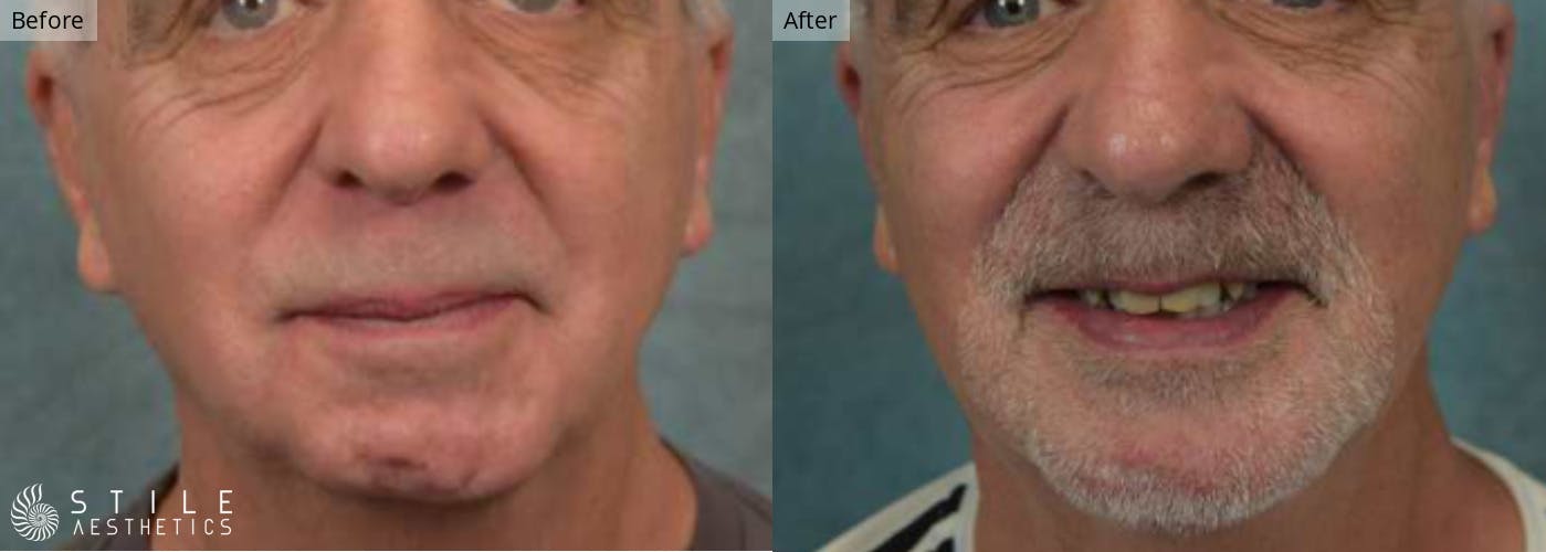 Chin Augmentation Before & After Gallery - Patient 252188 - Image 2