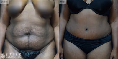 Tummy Tuck Before & After Gallery - Patient 316550 - Image 1