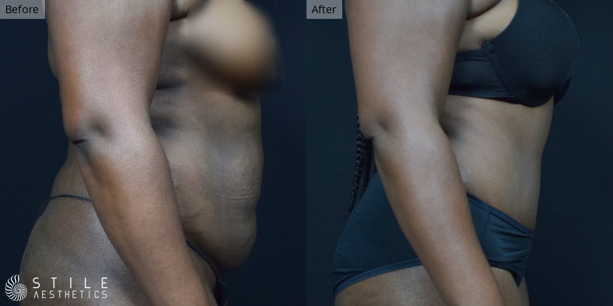 Tummy Tuck Before & After Gallery - Patient 316550 - Image 2