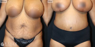 Tummy Tuck Before & After Gallery - Patient 213432 - Image 1
