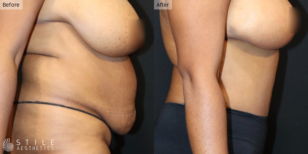 Tummy Tuck Before & After Gallery - Patient 213432 - Image 2