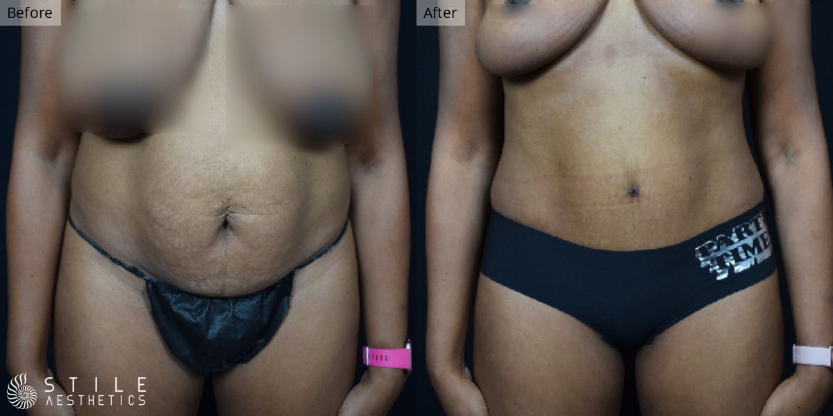 Tummy Tuck Before & After Gallery - Patient 157265 - Image 1