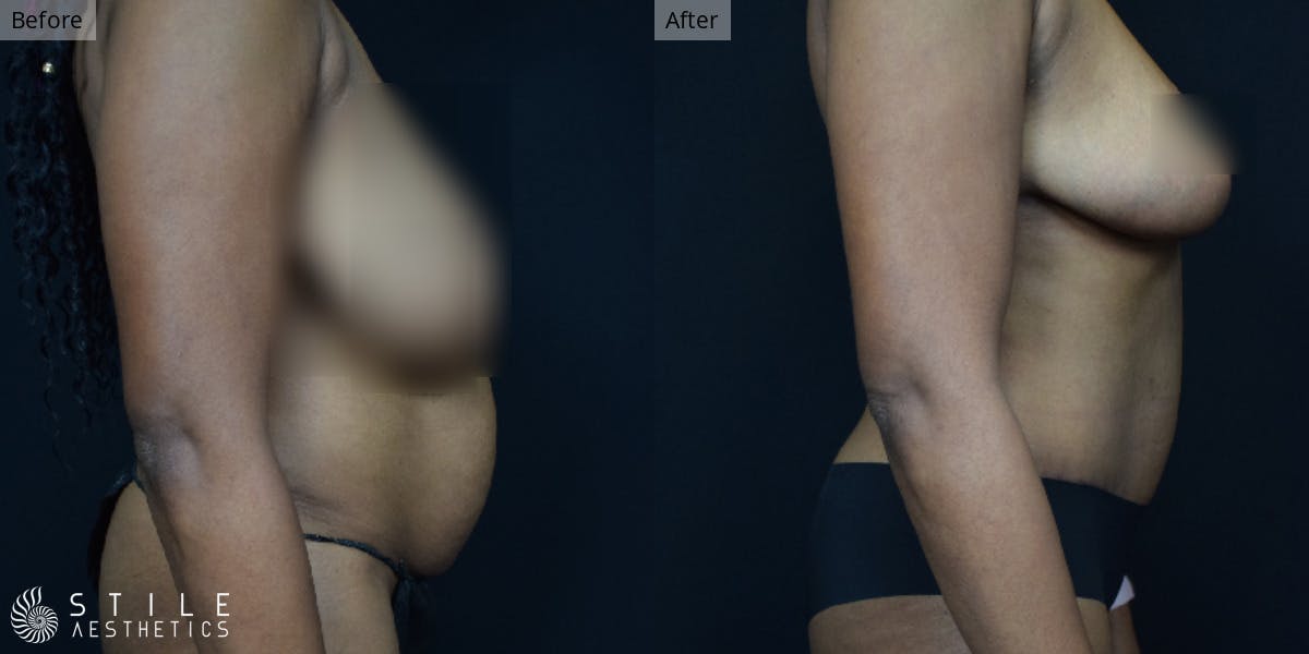 Tummy Tuck Before & After Gallery - Patient 157265 - Image 2