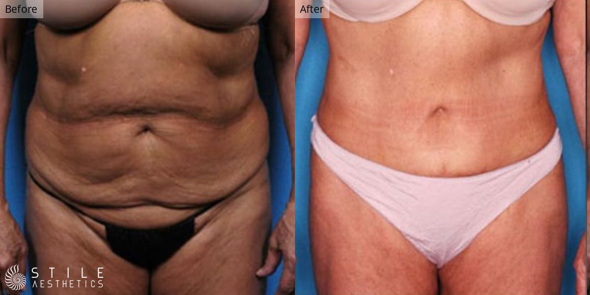 Tummy Tuck Before & After Gallery - Patient 367462 - Image 1