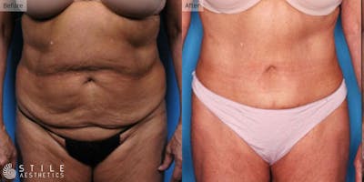 Tummy Tuck Before & After Gallery - Patient 367462 - Image 1