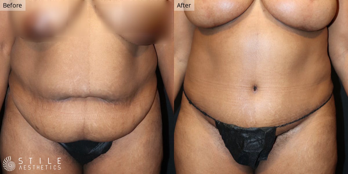 Tummy Tuck Before & After Gallery - Patient 258837 - Image 1