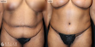 Tummy Tuck Before & After Gallery - Patient 258837 - Image 1