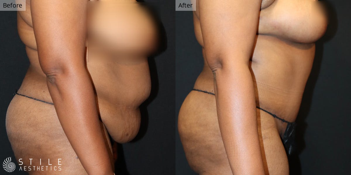 Tummy Tuck Before & After Gallery - Patient 258837 - Image 2