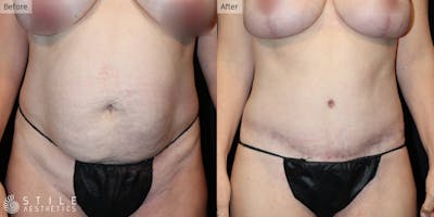 Tummy Tuck Before & After Gallery - Patient 234262 - Image 1