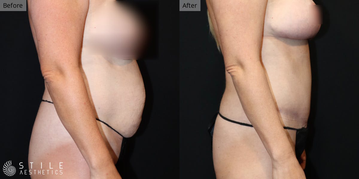 Tummy Tuck Before & After Gallery - Patient 234262 - Image 2