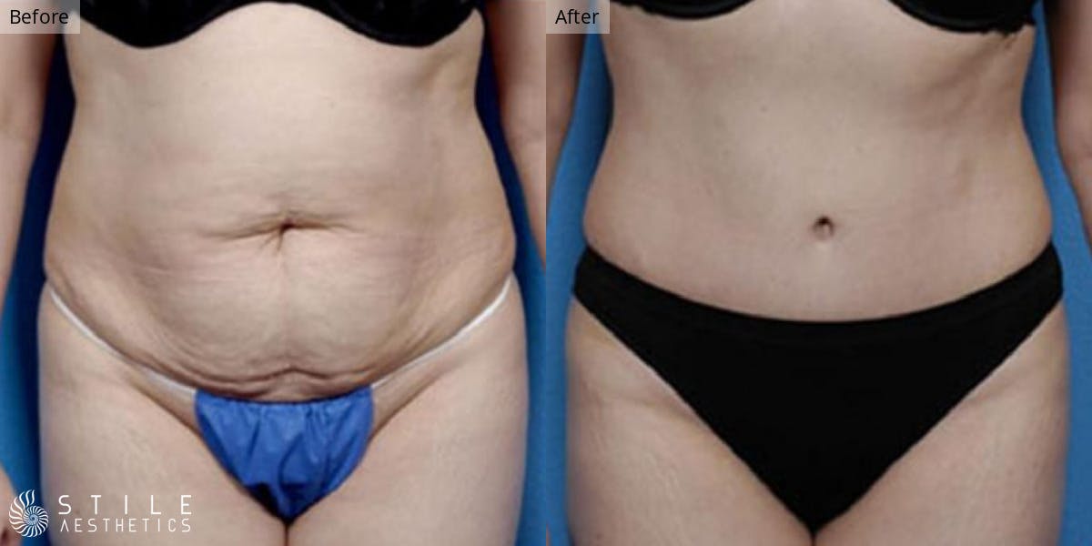 Tummy Tuck Before & After Gallery - Patient 451399 - Image 1