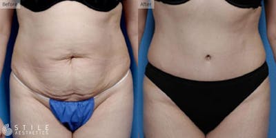 Tummy Tuck Before & After Gallery - Patient 451399 - Image 1