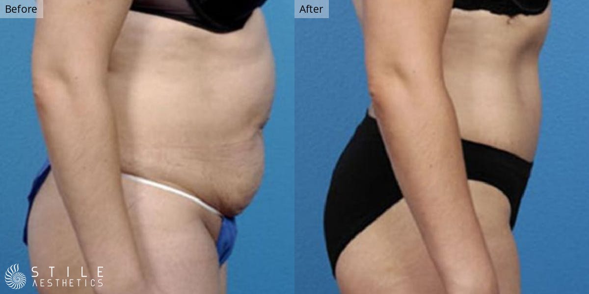 Tummy Tuck Before & After Gallery - Patient 451399 - Image 2