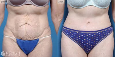 Tummy Tuck Before & After Gallery - Patient 276743 - Image 1