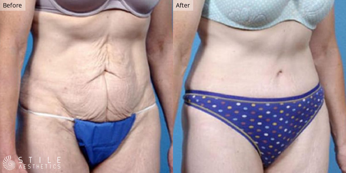 Tummy Tuck Before & After Gallery - Patient 276743 - Image 2