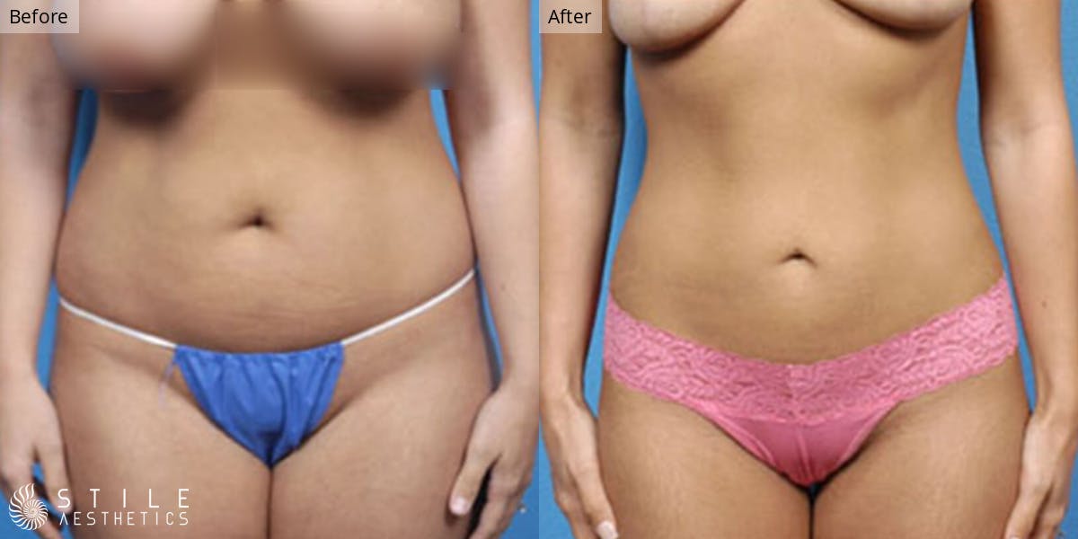 Tummy Tuck Before & After Gallery - Patient 102163 - Image 1