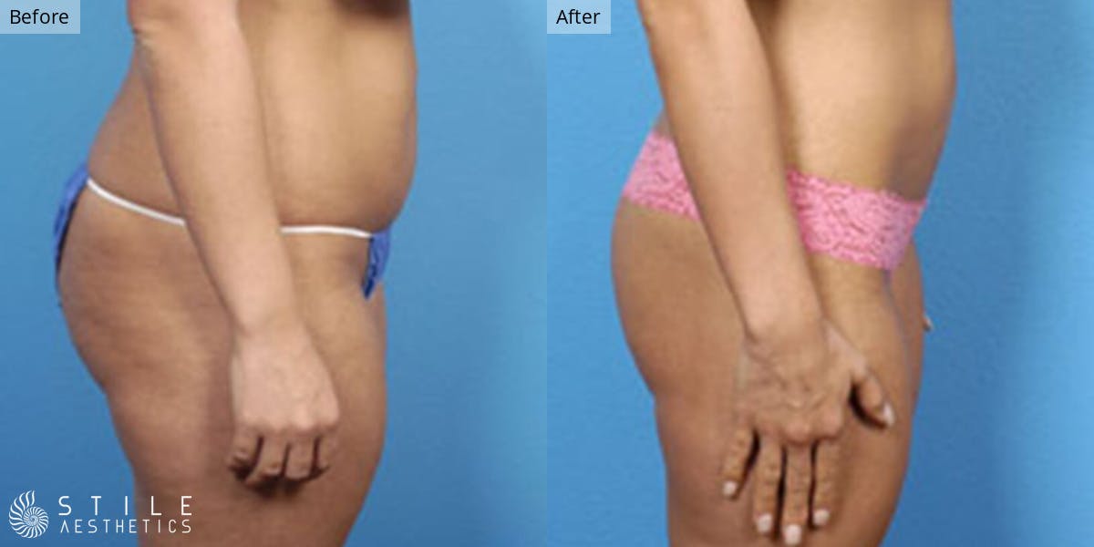 Tummy Tuck Before & After Gallery - Patient 102163 - Image 2