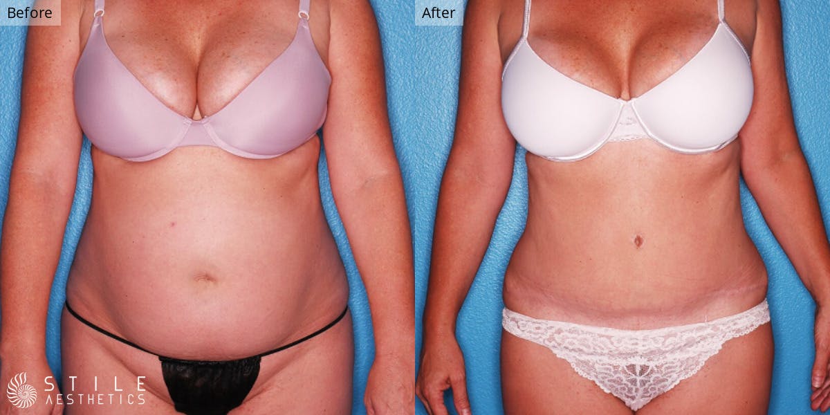 Tummy Tuck Before & After Gallery - Patient 261497 - Image 1