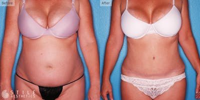 Tummy Tuck Before & After Gallery - Patient 261497 - Image 1