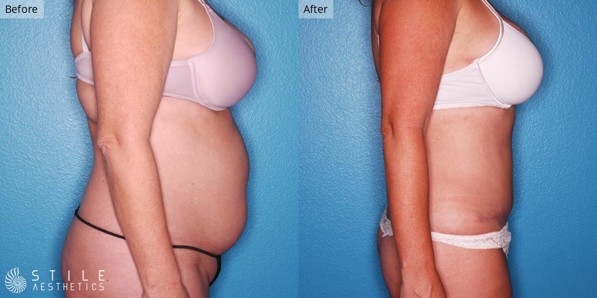 Tummy Tuck Before & After Gallery - Patient 261497 - Image 2