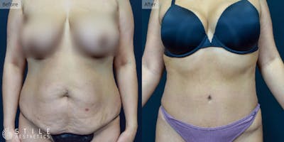 Tummy Tuck Before & After Gallery - Patient 129273 - Image 1