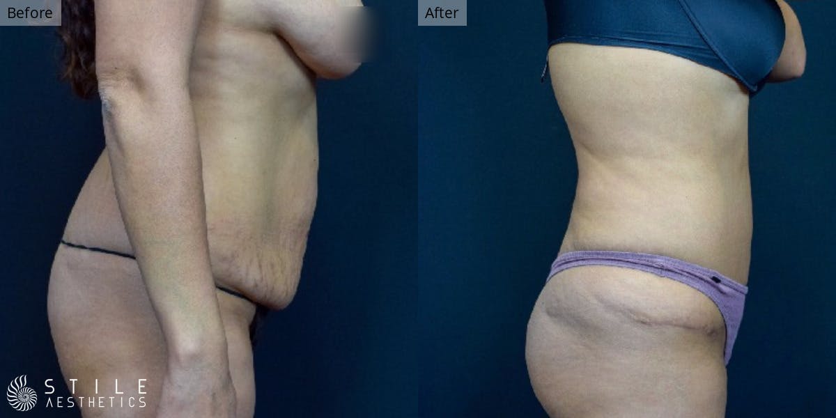 Tummy Tuck Before & After Gallery - Patient 129273 - Image 2