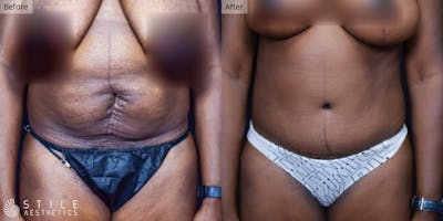 Tummy Tuck Before & After Gallery - Patient 338838 - Image 1