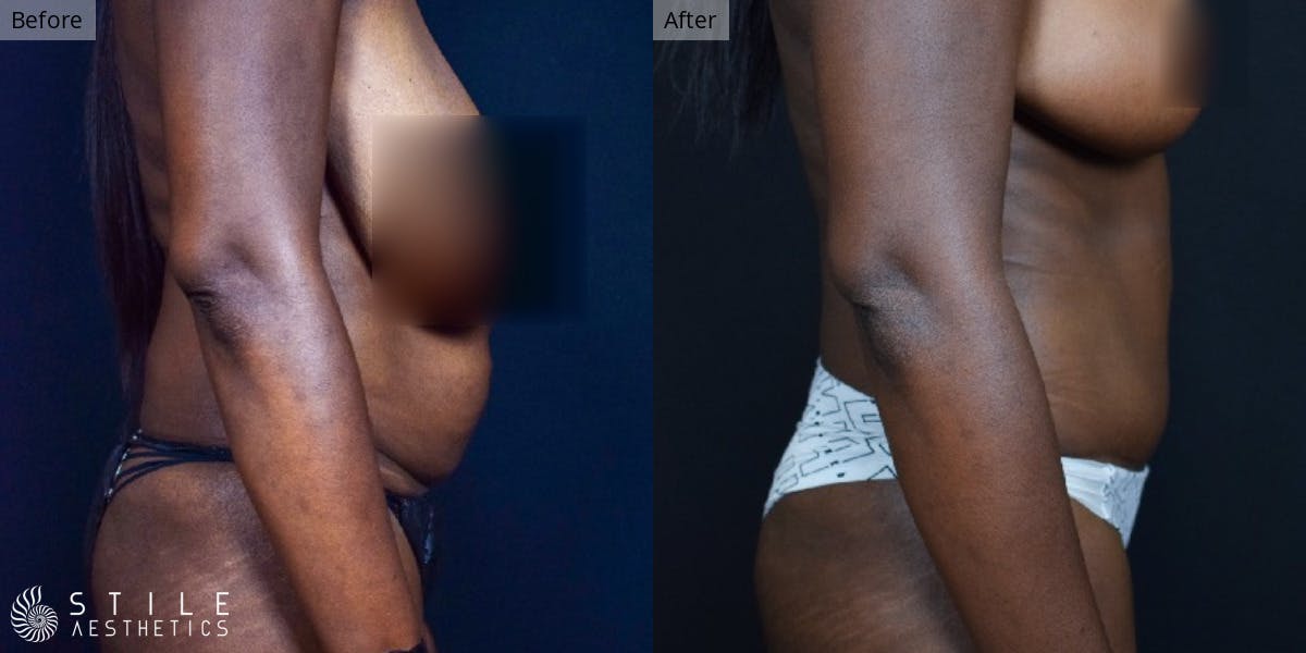 Tummy Tuck Before & After Gallery - Patient 338838 - Image 2
