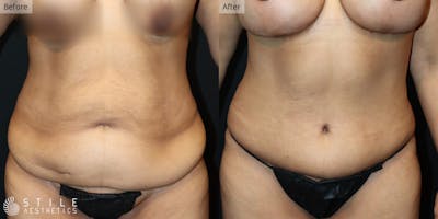 Tummy Tuck Before & After Gallery - Patient 376706 - Image 1