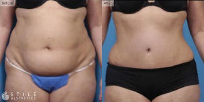 Tummy Tuck Before & After Gallery - Patient 300454 - Image 1