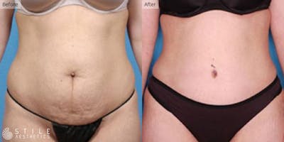 Tummy Tuck Before & After Gallery - Patient 128407 - Image 1