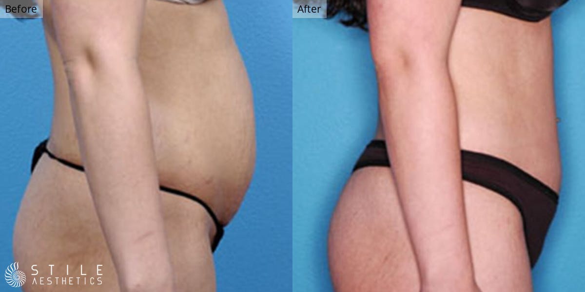 Tummy Tuck Before & After Gallery - Patient 128407 - Image 2