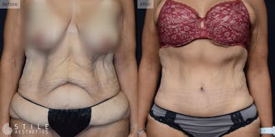 Tummy Tuck Before & After Gallery - Patient 186080 - Image 1