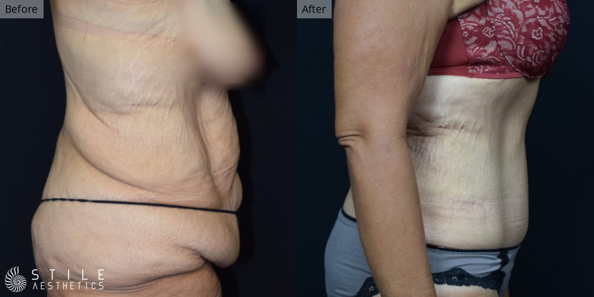 Tummy Tuck Before & After Gallery - Patient 186080 - Image 2