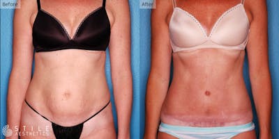 Tummy Tuck Before & After Gallery - Patient 487445 - Image 1