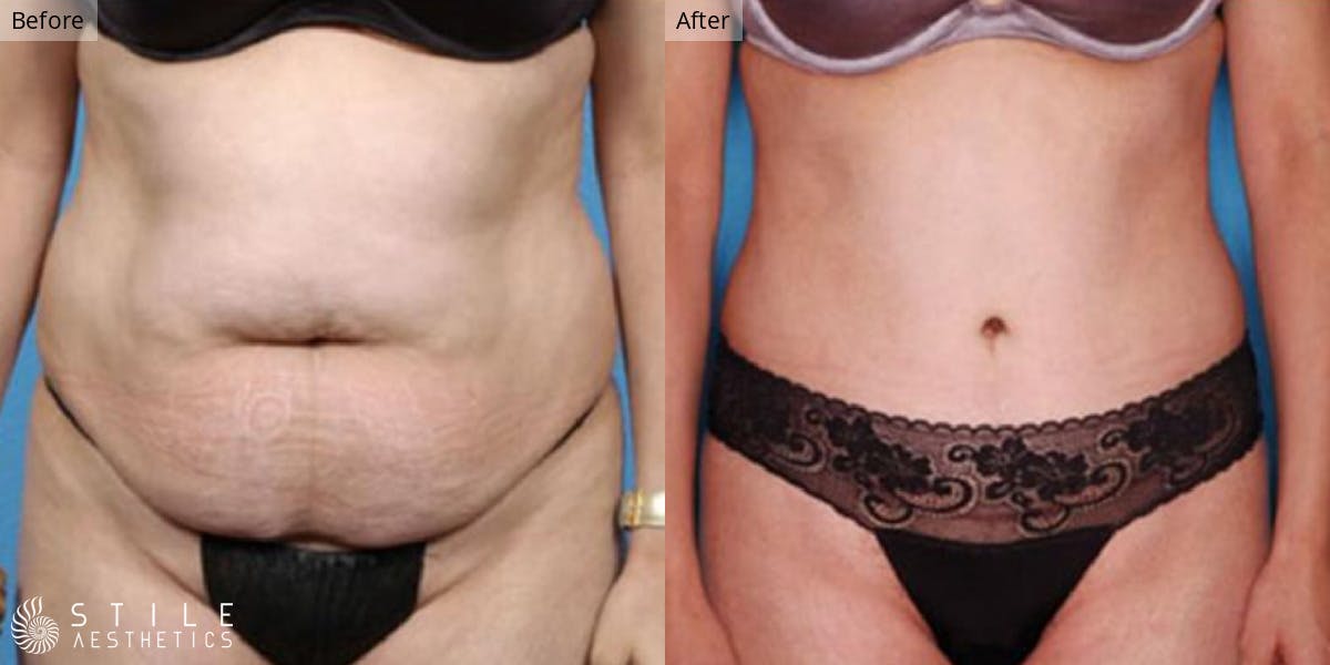 Tummy Tuck Before & After Gallery - Patient 106568 - Image 1