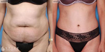Tummy Tuck Before & After Gallery - Patient 106568 - Image 1