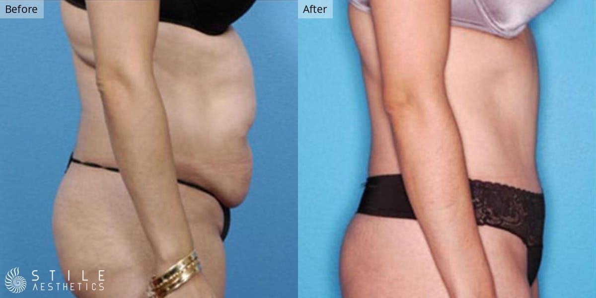 Tummy Tuck Before & After Gallery - Patient 106568 - Image 2