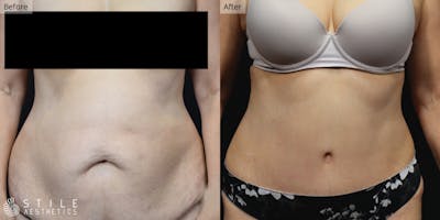 Tummy Tuck Before & After Gallery - Patient 138466 - Image 1