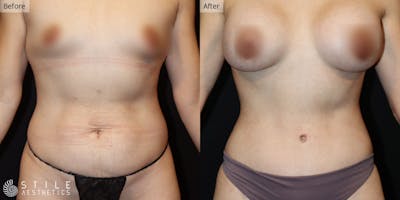 Tummy Tuck Before & After Gallery - Patient 372417 - Image 1