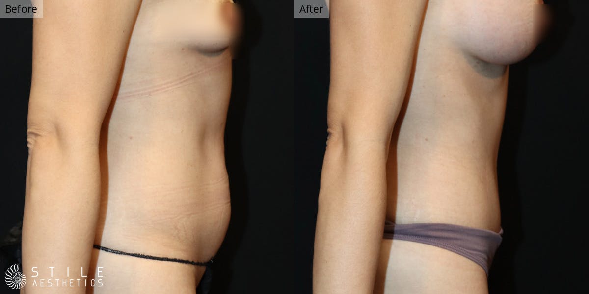 Tummy Tuck Before & After Gallery - Patient 372417 - Image 2
