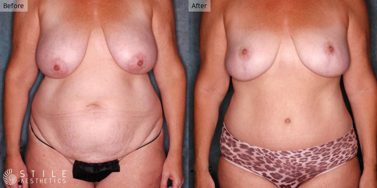 Mommy Makeover Before & After Gallery - Patient 334683 - Image 1