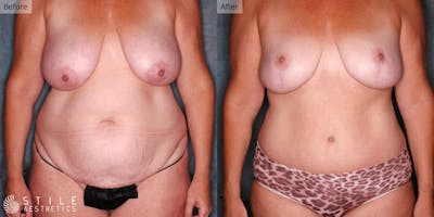 Mommy Makeover Before & After Gallery - Patient 334683 - Image 1